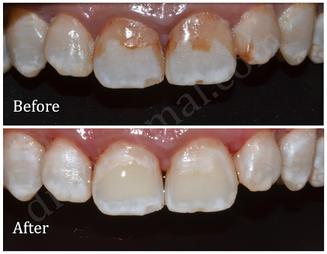 Teeth Whitening for Dental Fluorosis