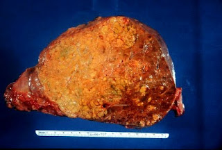 Cancer Liver