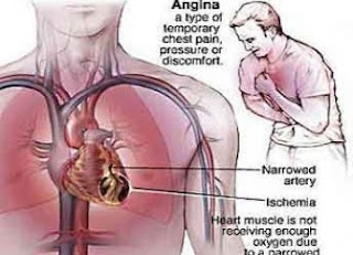 Gejala Awal Seseorang Mengalami Sakit Jantung [ www.BlogApaAja.com ]