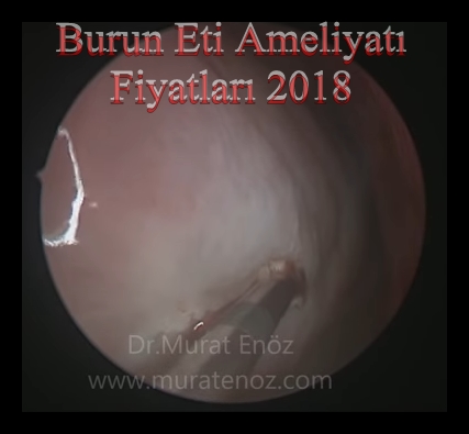 Burun eti ameliyatı fiyatı 2018 - Burun etlerinin radyofrekans ile küçültülmesi fiyatı 2018 - Konka radyofrekansı fiyatı 2018 - Burun eti tedavisi ücreti  - Burun eti büyümesi tedavisi ücreti 2018 - Konka hipertrofisi tedavisi ücreti 2018 - Konka radyofrekansı fiyatı 2018 - Burun eti tedavisi ücreti 2018