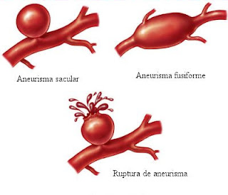 Aneurisma sacular e fusiforme