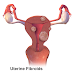 Uterine Fibroids: Types, Symptoms and Options for Management