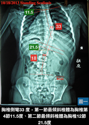 脊椎側彎, 脊椎度數, 脊椎側彎矯正, 脊椎側彎治療, 脊椎側彎矯正成功案例