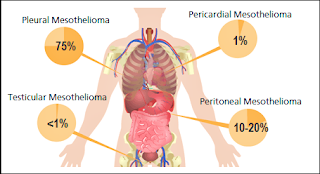 Pleural Mesothelioma and Lung Cancer - Kind of Cancer Deadly