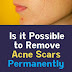 Is it Possible to Remove Acne Scars Permanently?
