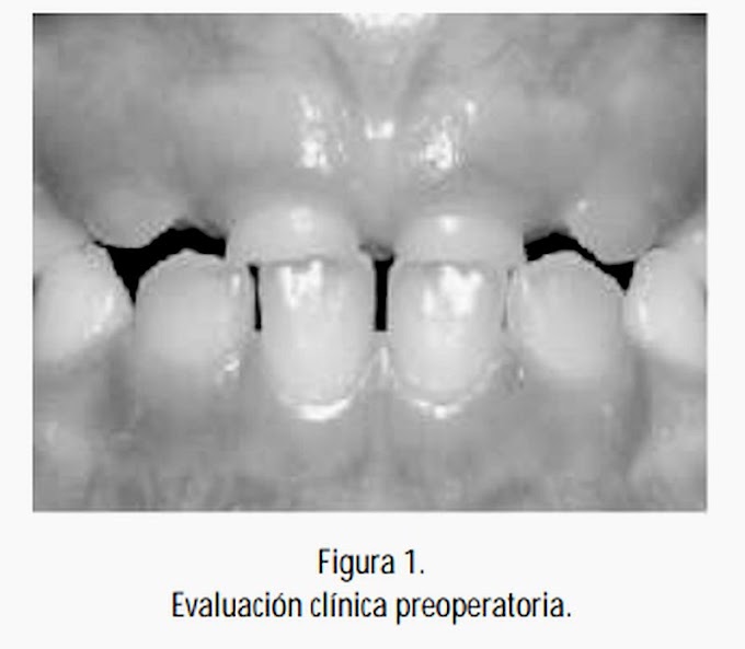 PDF: MESIODENTS - Tratamiento quirúrgico en Odontopediatría