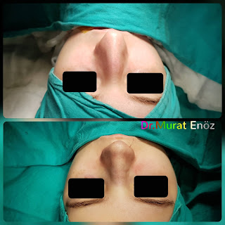 Female Rhinoplasty Istanbul Turkey, Nose Job in Women, Rhinoplasty Istanbul