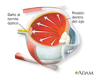 glaucoma