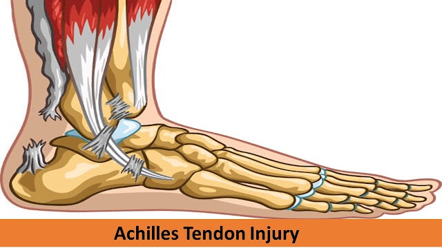 Achilles Tendon Injury, Achilles Tendonitis or Rupture 