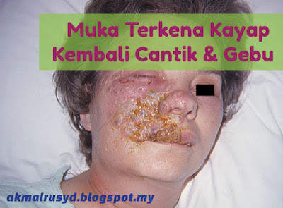 A Healthy Living: Muka Terkena Kayap Kembali Cantik Dan 