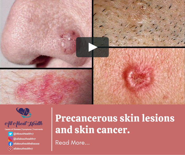 Precancerous skin lesions and skin cancer.