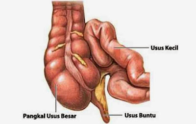 Penyakit Apendisitis ( Gejala Usus Buntu ) dan Cara Mengobati Usus Buntu