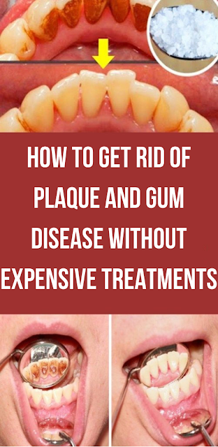 How To Get Rid Of Plaque And Gum Disease Without Expensive Treatmens