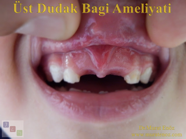 Dudak bağı ameliyatı - Dudak bağı kesilmesi - Dudak bağı tedavisi - Üst dudak bağı kesilmesi - Dudak bağı kesildikten sonra ağrı kesici ilaç - Dudak bağı ameliyatı sonrası yapılması gerekenler