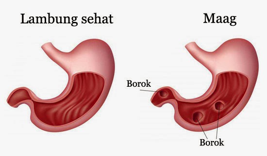 Gejala, Penyebab dan Pengobatan Maag (Gastritis) | Medkes