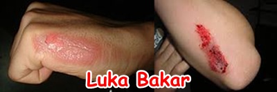 Pengobatan Herbal Luka Bakar Dengan Cepat