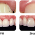 Zirconium, The New Leader in Dentistry