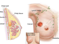Obat Kanker Payudara yang Bagus 