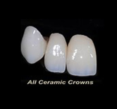 ceramic cap for teeth