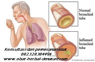 obat batuk paru,obat paru paru basah,obat batuk menahun,obat batuk TBC,obat batuk akibat rokok,obat batuk paru paru,obat paru paru bocor,obat batuk berlendir,obat batuk berdarah