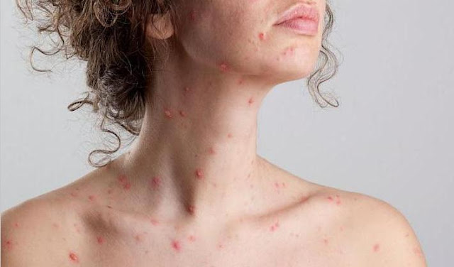 Home Remedies Chickenpox Disease and Facts