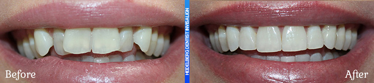 Invisalign Melbourne Before & After Smile Gallery