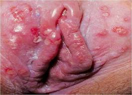 syphilis signs & symptoms 