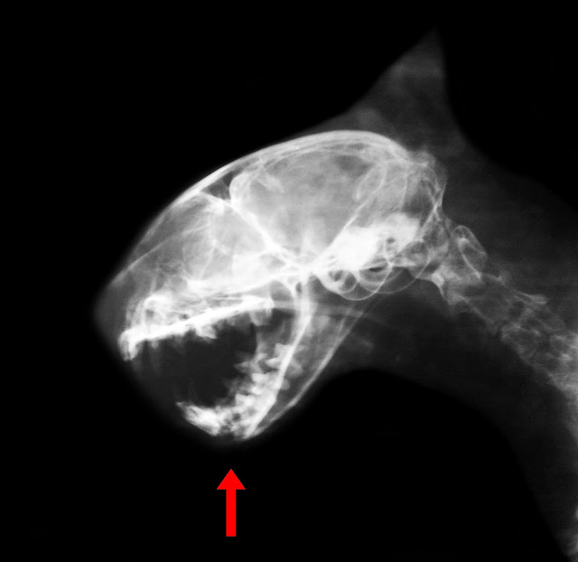 fractura de mandibula