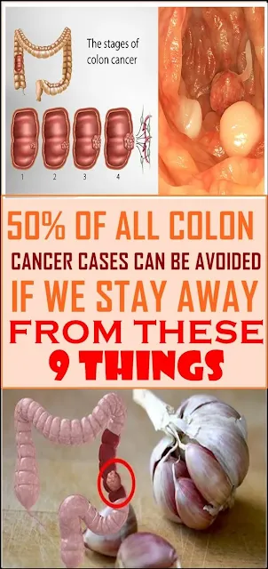 50% Of All Colon Cancer Cases Can Be Avoided By Avoiding These 9 Things!