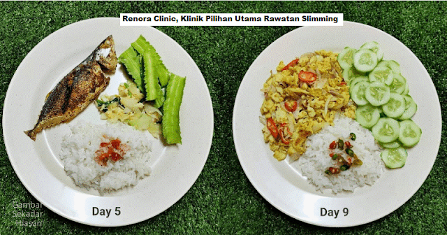 Renora Clinic, Klinik Pilihan Utama Rawatan Slimming