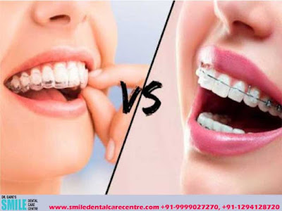 Best Invisible Aligner Treatment or Best Braces Treatment in Faridabad