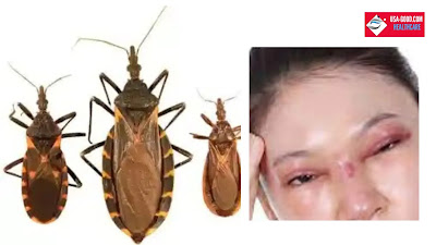What is Chagas disease?