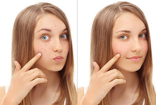Acne, tips acne, clean for acne