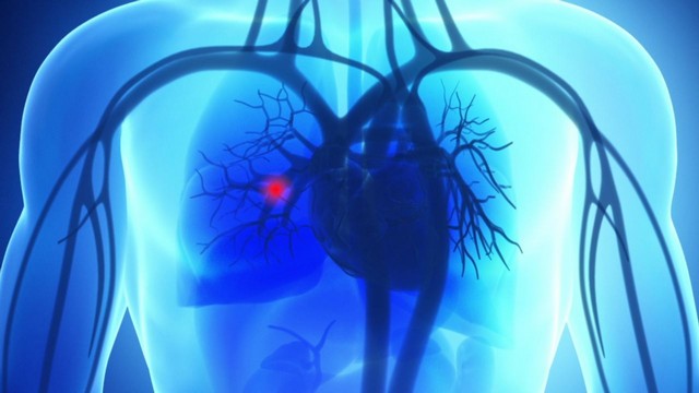 Emboli Paru-paru, Penyebab dan Pencegahannya
