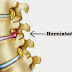 Qué es un hernia de disco y el dolor de espalda / Cuáles son los síntomas de hernia de disco?