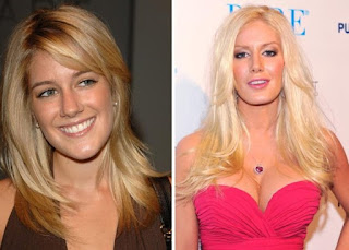 Kegagalan Operasi Plastik Heidi Montag