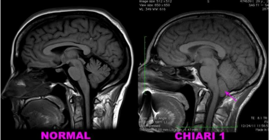 Arnold Chiari Malformation