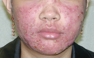 Prescription Acne Medication Oral