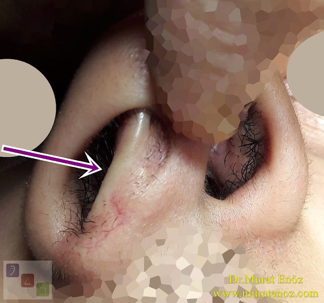 Caudal septal deviation - What is a caudal septum deviation? - Treatment of caudal septum deviation - Signs of caudal septum deviation - Surgery for caudal septum deviation - Anterior septal dislocation - Anterior nasal septum deviation - Caudal septoplasty