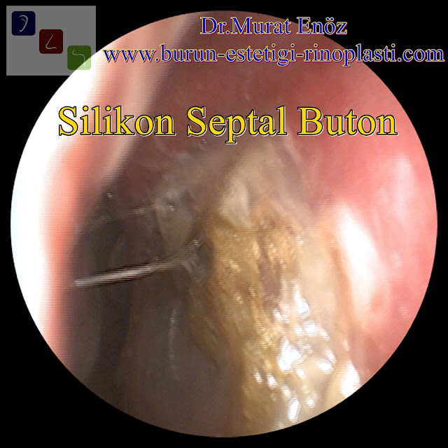 Silikon septal buton - Nazal septal buton - Septal buton uygulaması