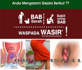 Obat Ambeien dan Obat Wasir AmbeJoss