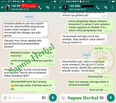 Tanpa Operasi, Begini Cara Menghilangkan Lipoma Secara Alami