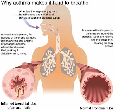 What Does Asthma Feel