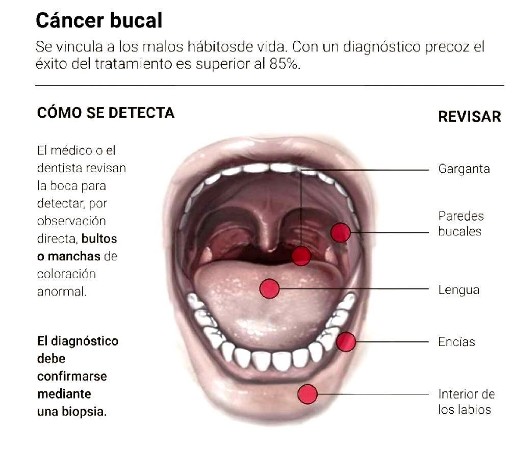 Cáncer Bucal