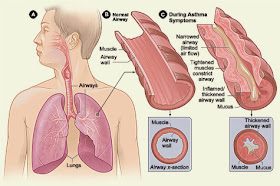 What is Asthma, Symptoms,Causes & Treatment
