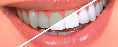 Tẩy trắng răng bằng đèn laser như thế nào?