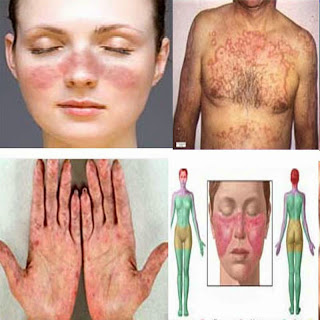 Gejala Lupus,Penyebab Penyakit Lupus Dan Mencegah Penyakit Lupus