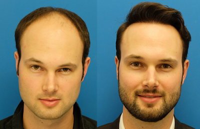 Hair transplant manchester