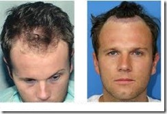 Hair Transplant cost in Pakistan