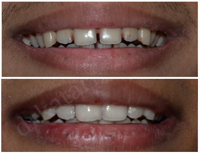 Orthodontic Treatment of Spacing Between Teeth done with Removable Clear Aligner at Jamnagar